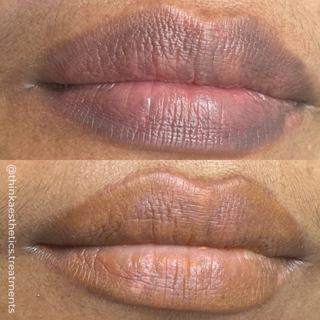 Before photo of pigmented dark lips, with after photo of colour corrected lips using semi-permanent makeup by @thinkaesthetics.treatments
