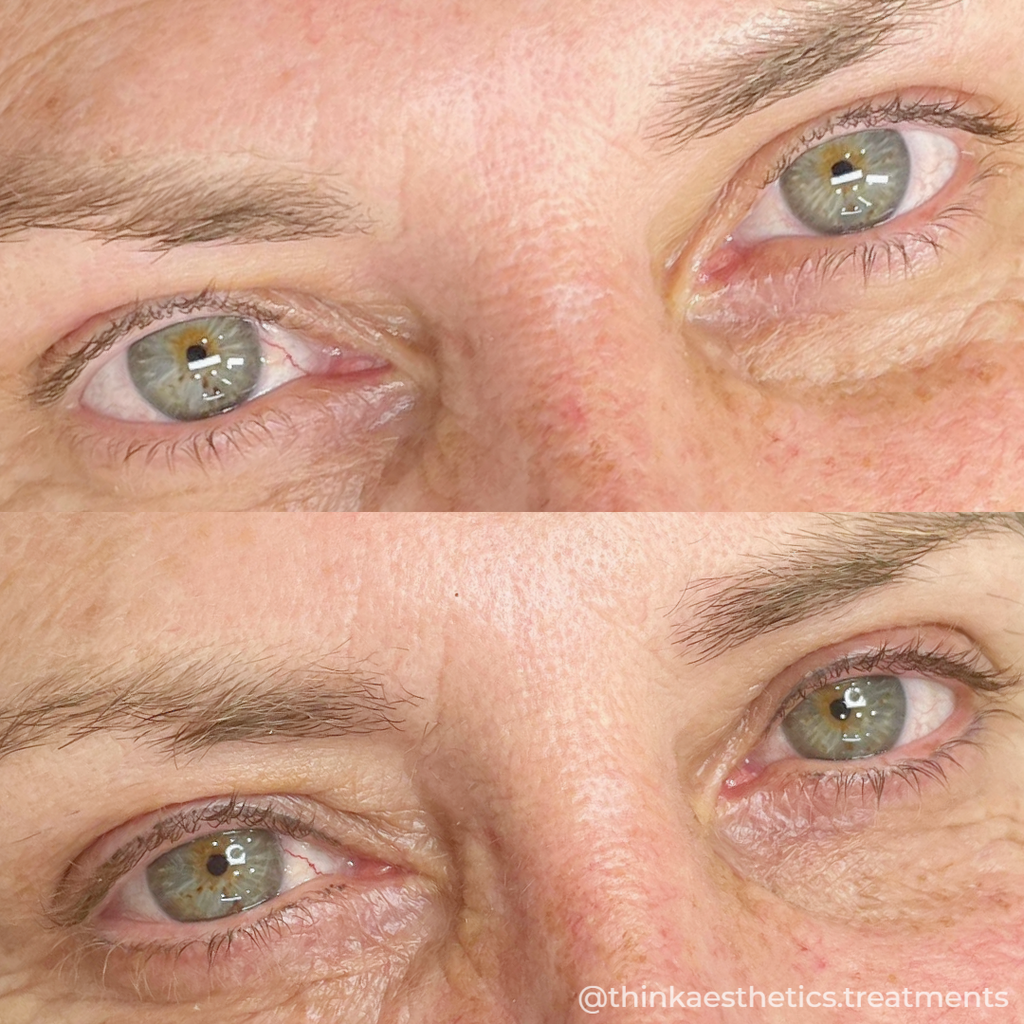 Cosmetic Tattoo before photo of portrait cropped to eyes, with after photo showing healed eyeliner using semi-permanent makeup techniques by @thinkaesthetics.treatments